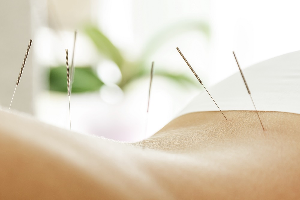 medical acupuncture from Holistic Therapist in Birmingham and Brierley Hill